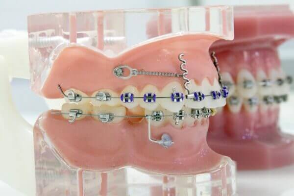ortodoncija-odrasli-7
