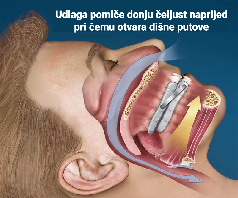 udlaga protiv hrkanja i apneje u snu