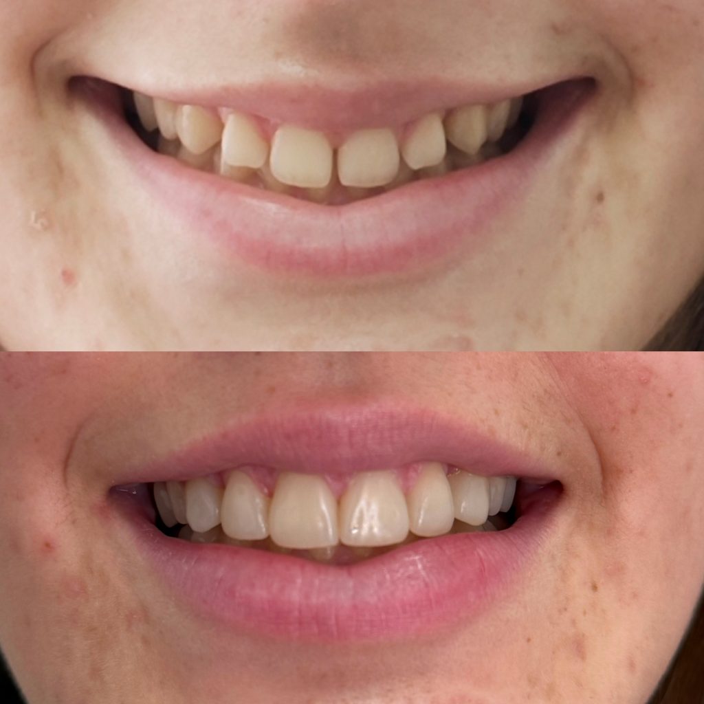 kompozitne ljuskice
veneers